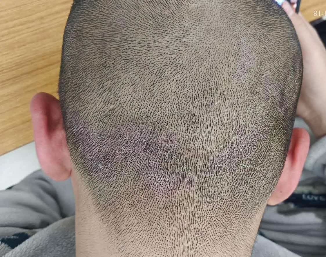 大家好,头皮长疙瘩这个事儿为什么一直就治不好呢?