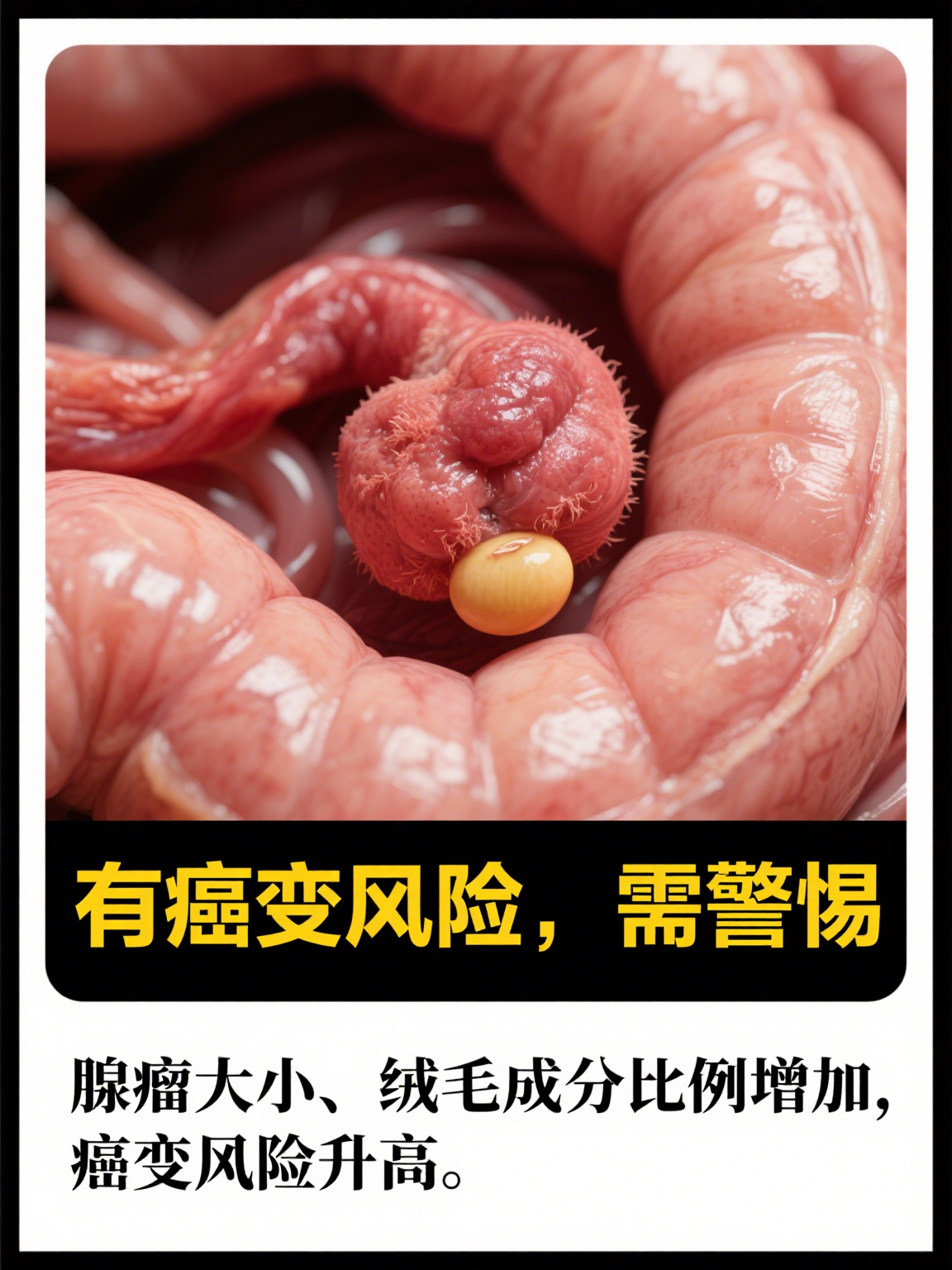 绒毛管状腺瘤是什么意思?