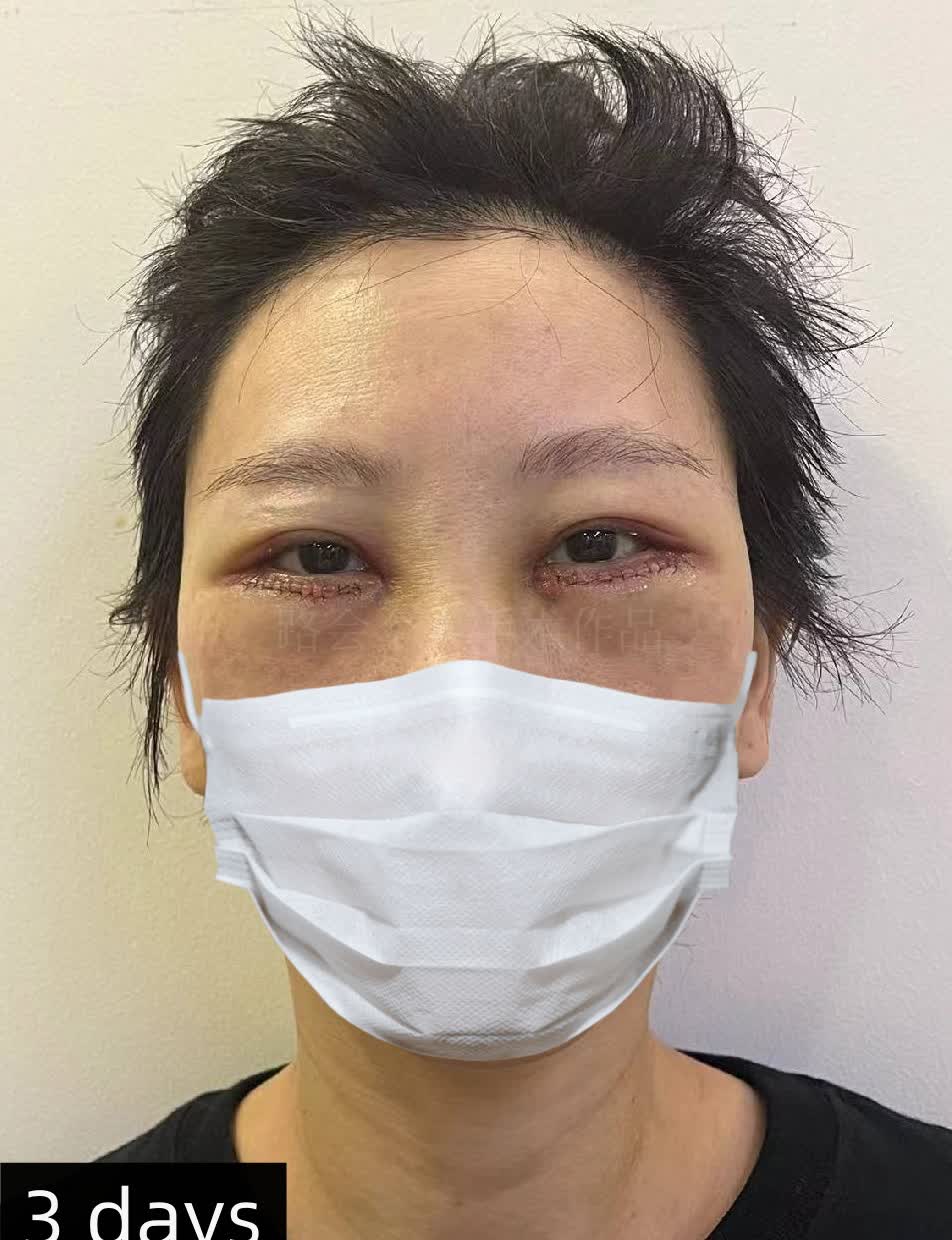 图1:泪沟明显,眼袋松弛,整个人显老,显疲惫,选择用膨体填充泪沟,使