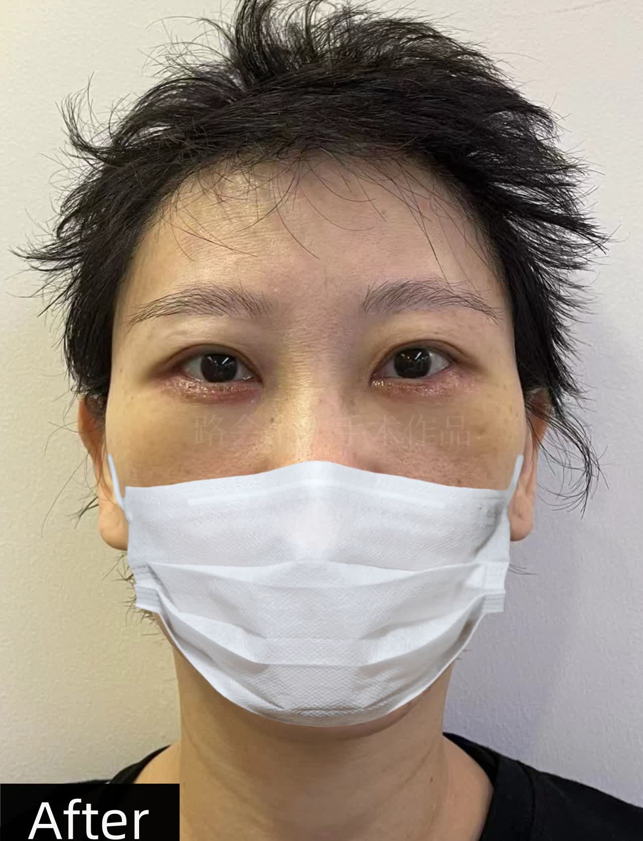 图1:泪沟明显,眼袋松弛,整个人显老,显疲惫,选择用膨体填充泪沟,使
