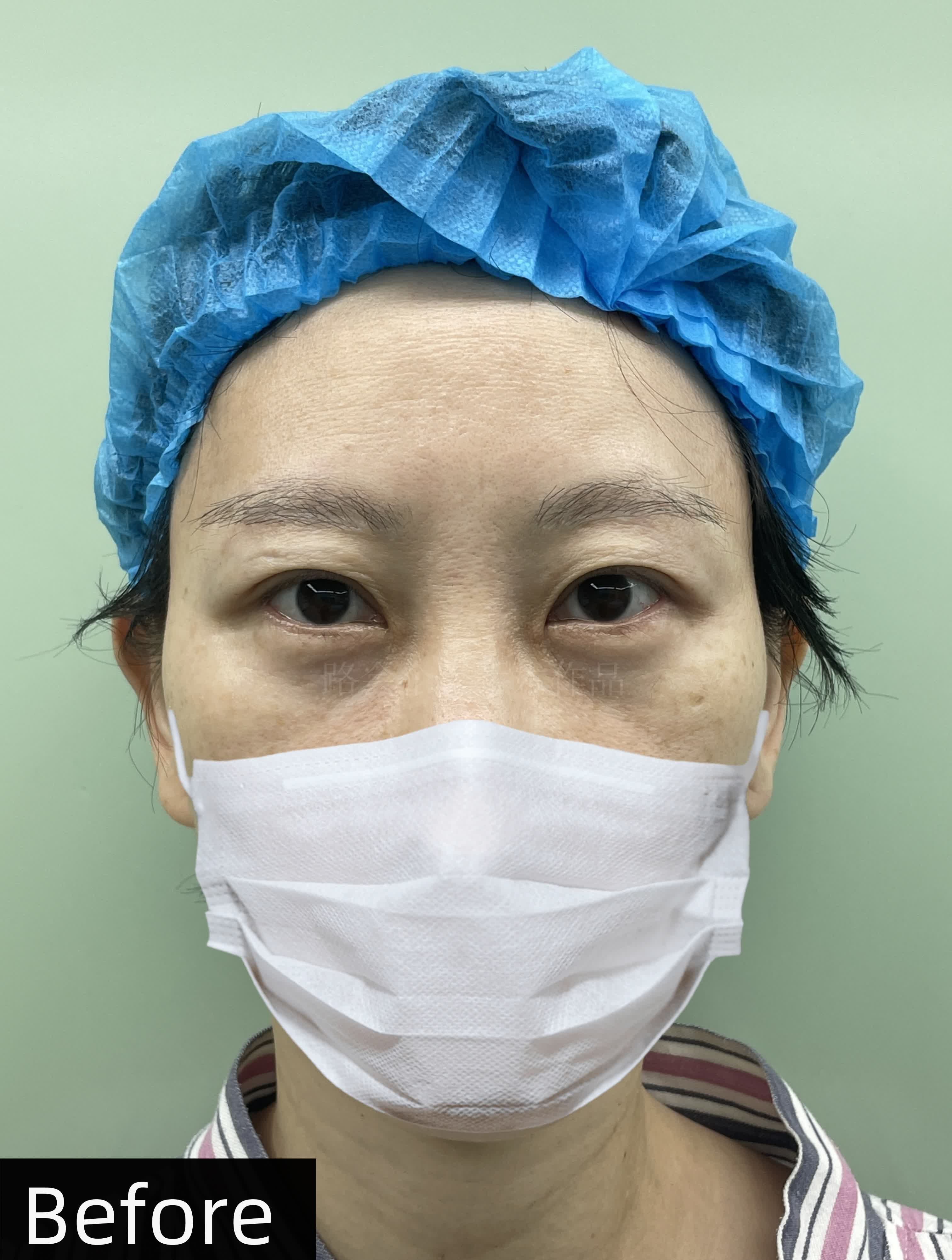 图1:泪沟明显,眼袋松弛,整个人显老,显疲惫,选择用膨体填充泪沟,使