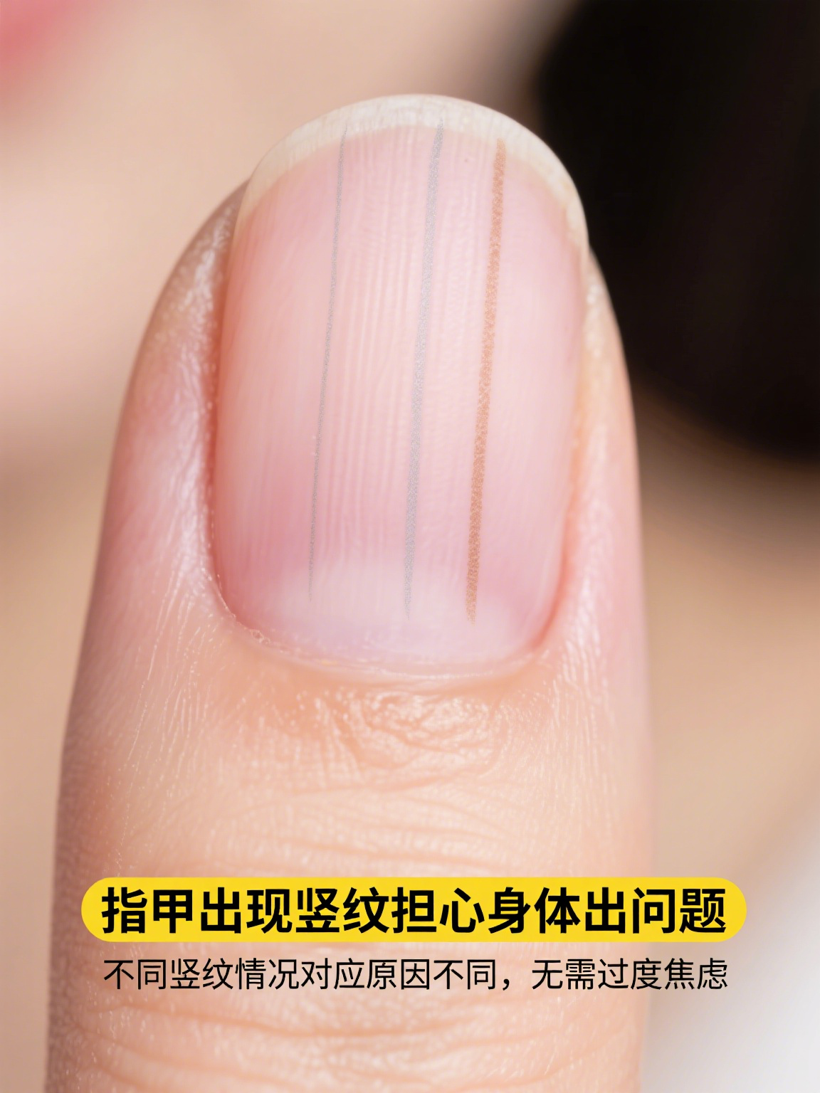 指甲有竖纹是身体的什么原因 指甲上出现竖纹,很多人会担心是不是身体