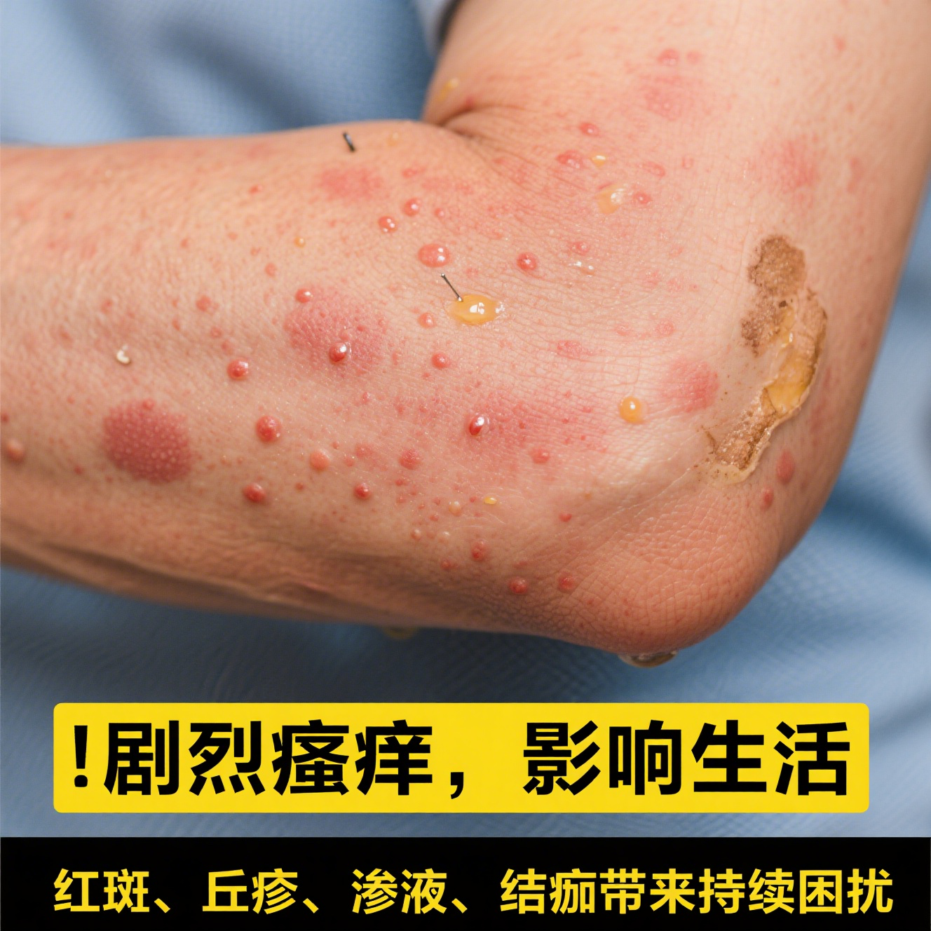 其主要表现为皮肤出现红斑,丘疹,伴有剧烈瘙痒,严重时还会渗液,结痂