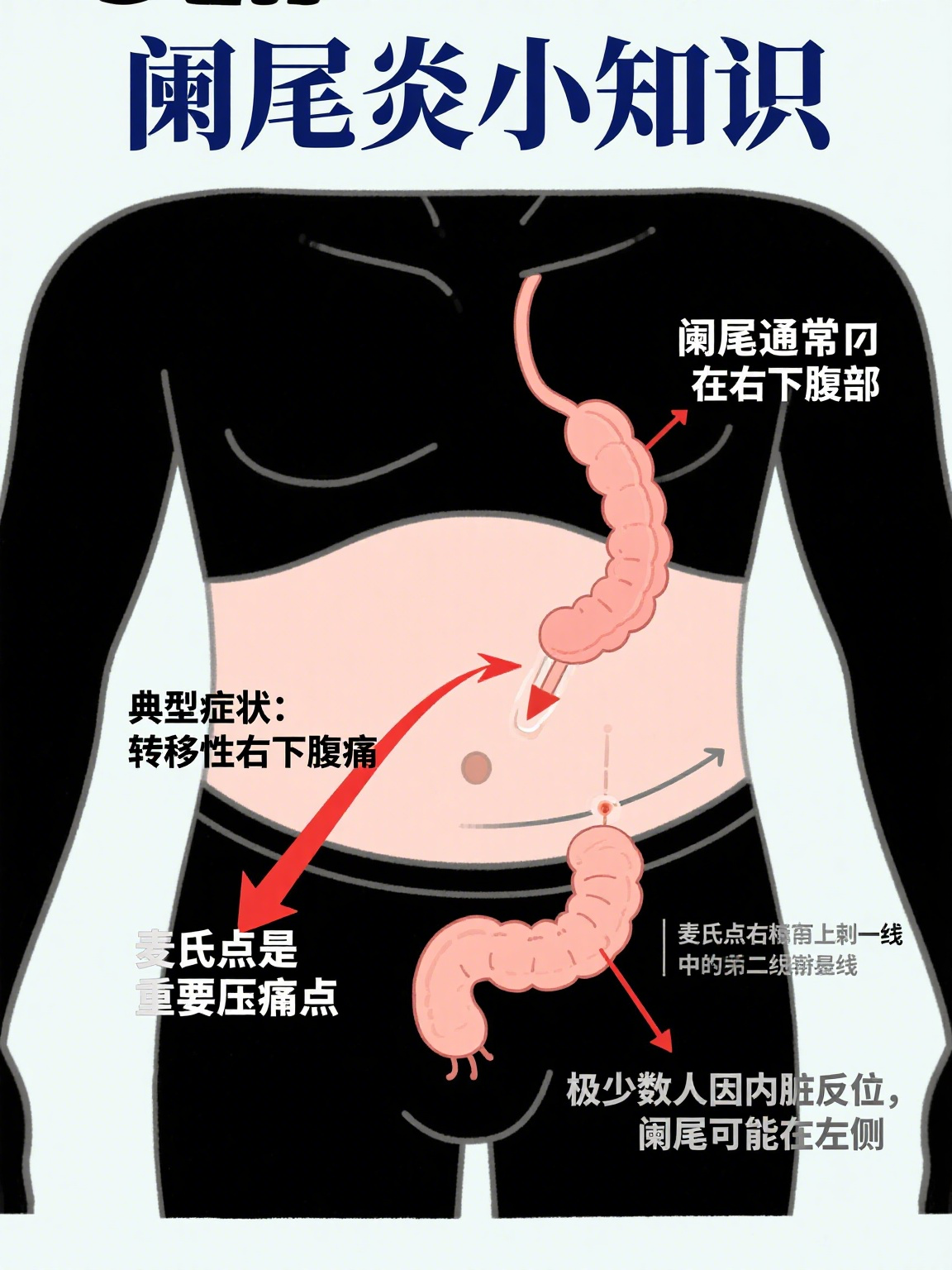 阑尾炎和盆腔炎的症状区别为什么在线