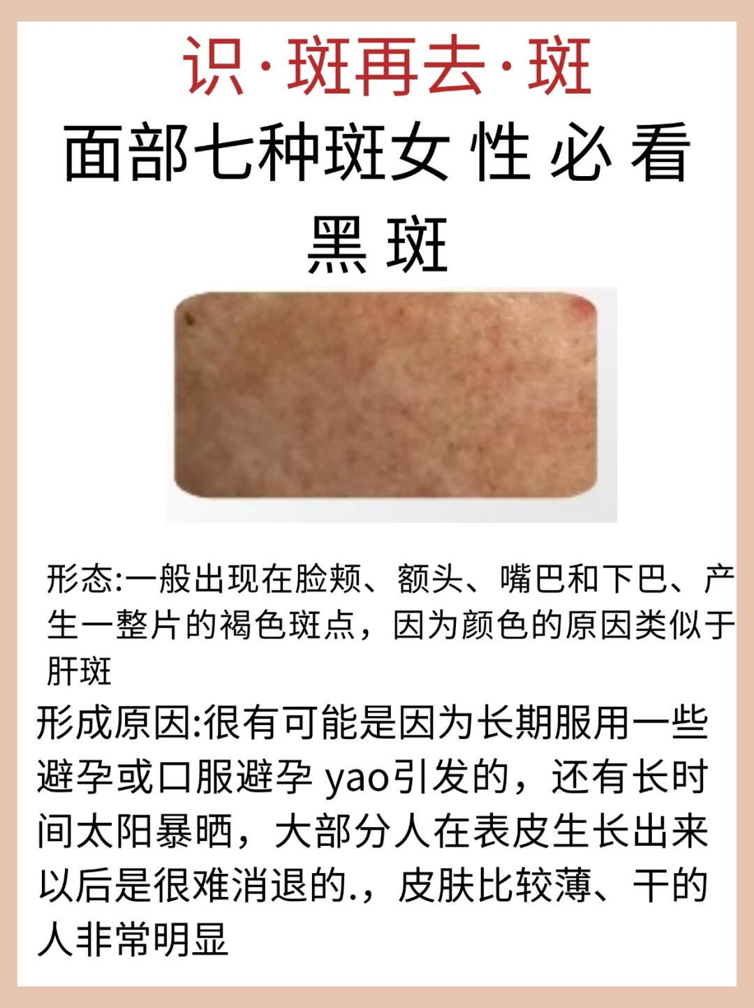 唤美计划 黑 褐 斑 形态黑褐 斑的颜色在身体疲劳或月经阶段开始转