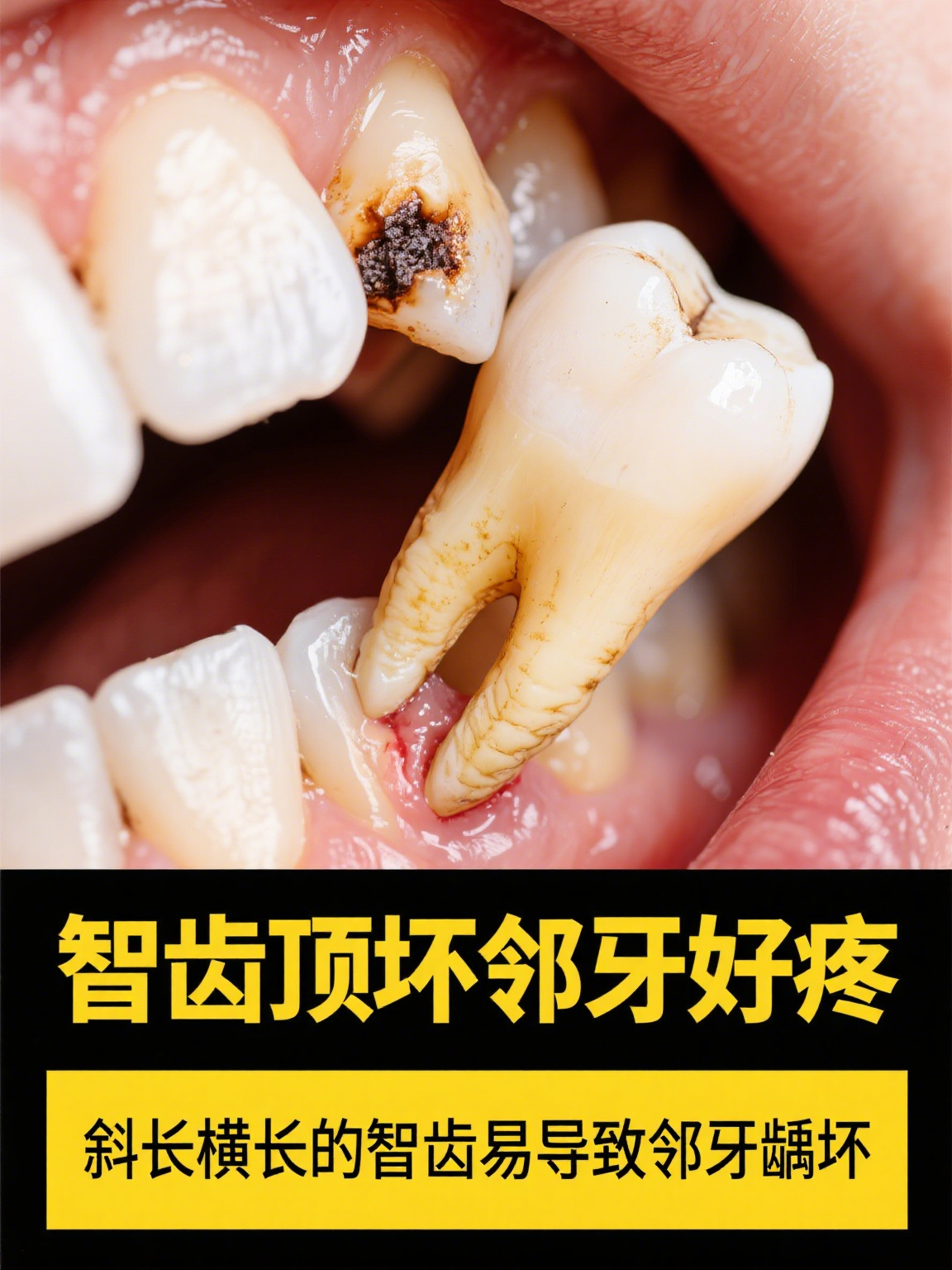 立事牙拔了好还是不拔好