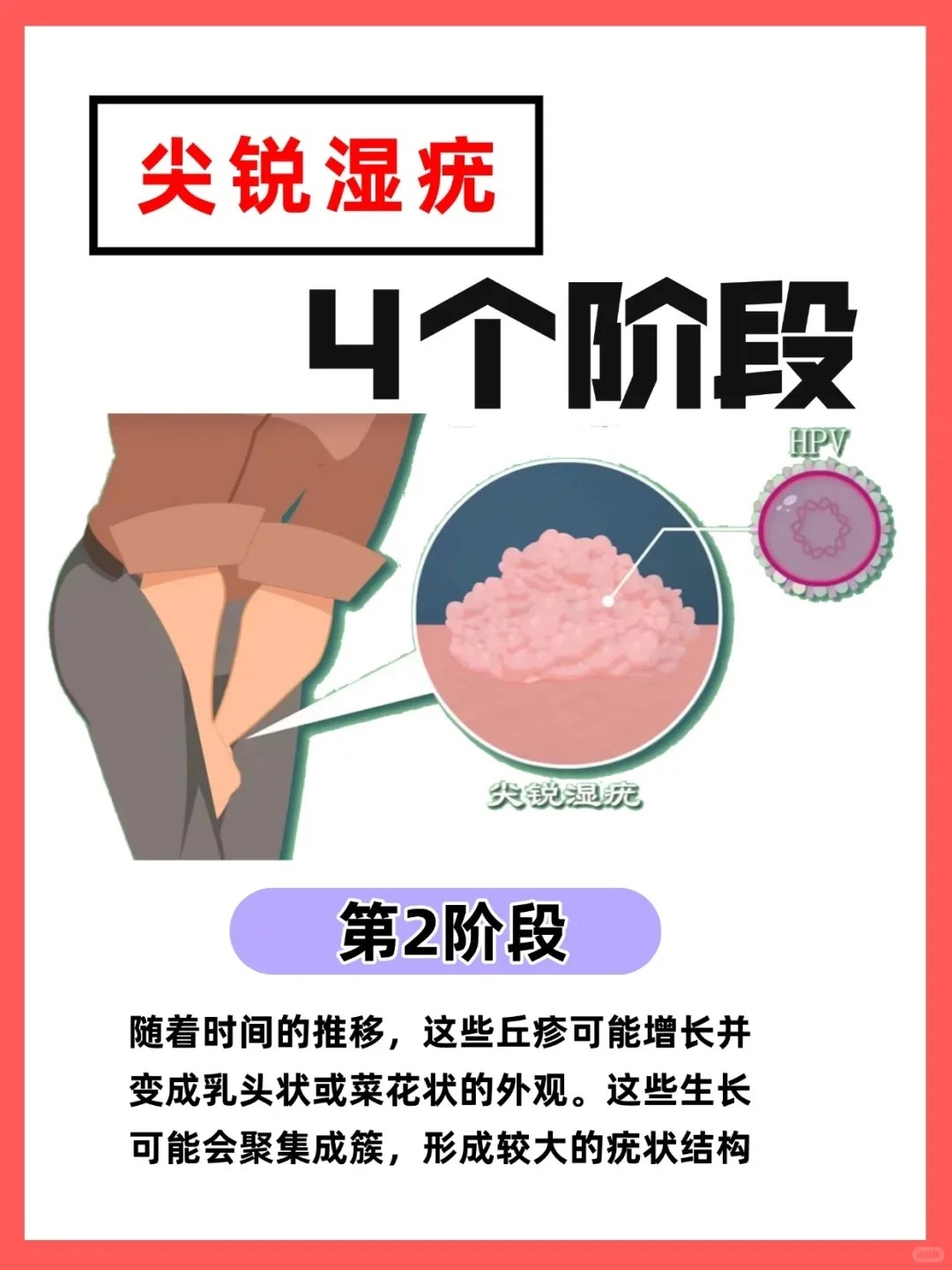女性湿锐疣初期图片 女性尖锐湿疣初期,往往不易被察觉