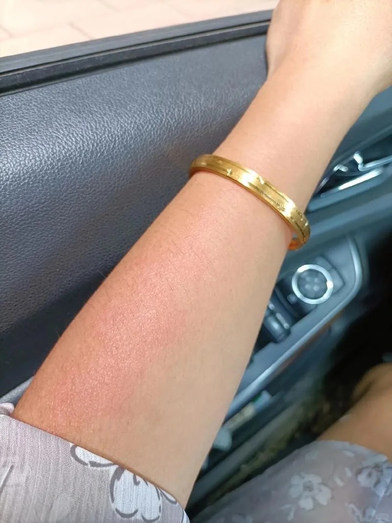 日光性皮炎 日光性皮炎,又称晒伤或日照性皮炎,是皮肤过度暴露于紫外