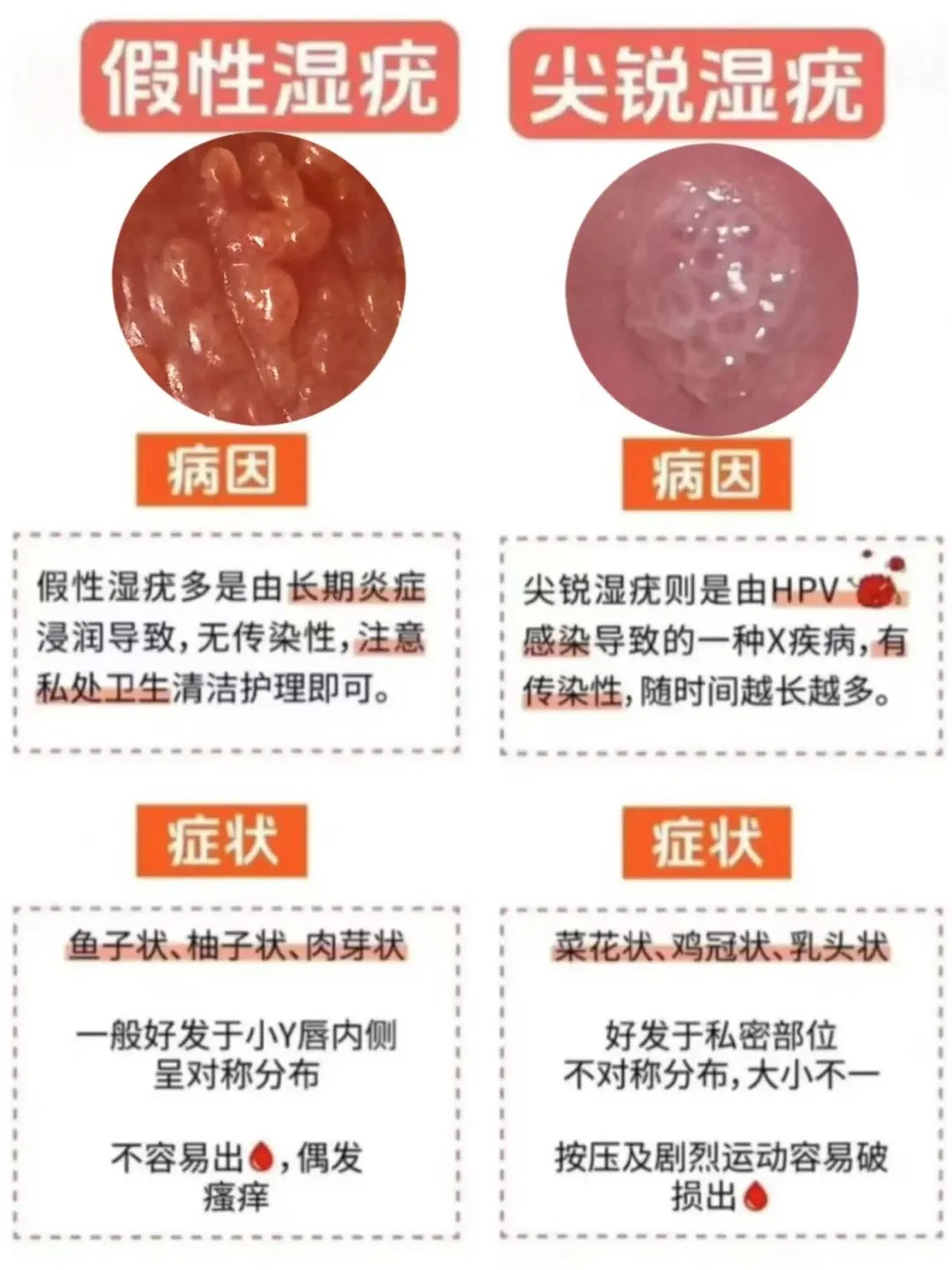 尖锐湿疣是一种由人乳头瘤病毒(hpv)感染引起的性传播疾病,其疣体形态