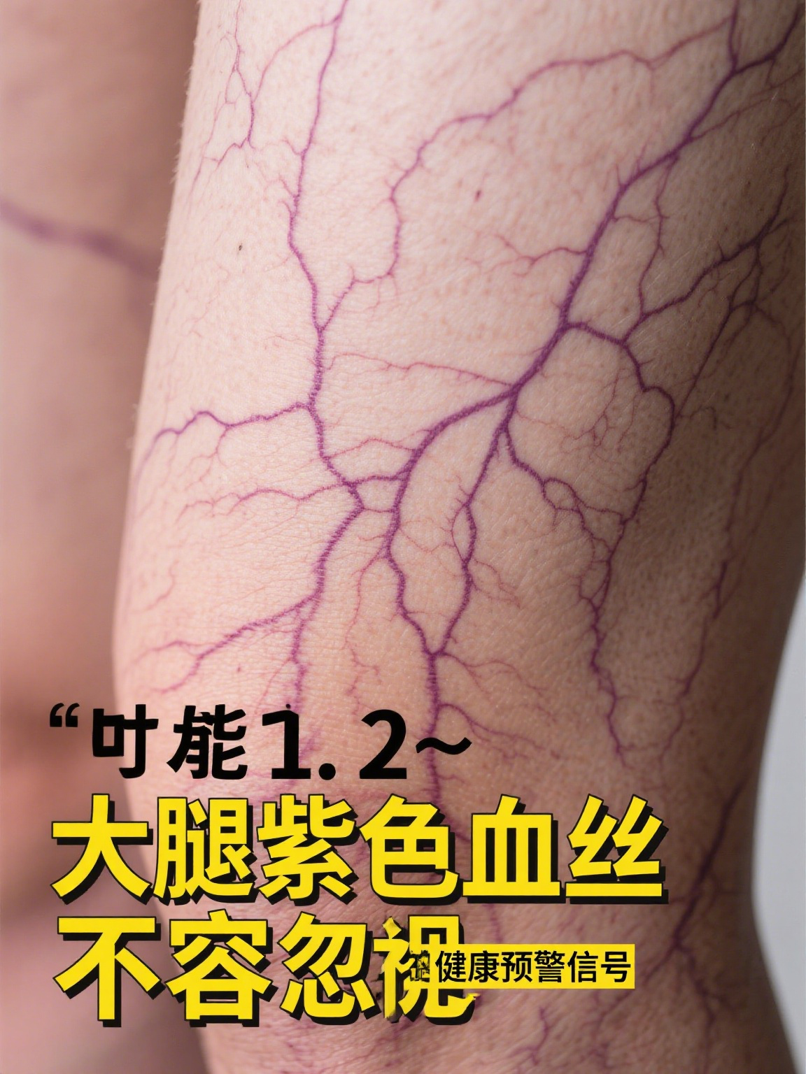 大腿紫色血丝要警惕了 当大腿上冒出一丝丝紫色纹路