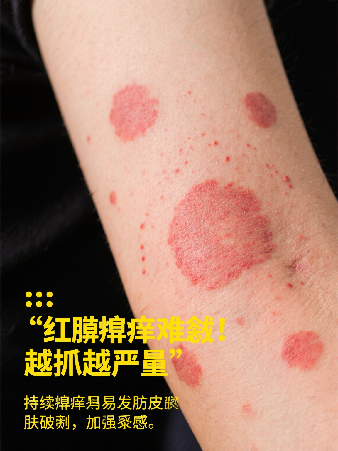 皮肤红色斑疹 皮肤红色斑疹是皮肤上常见的异常表现,像小面积的红色