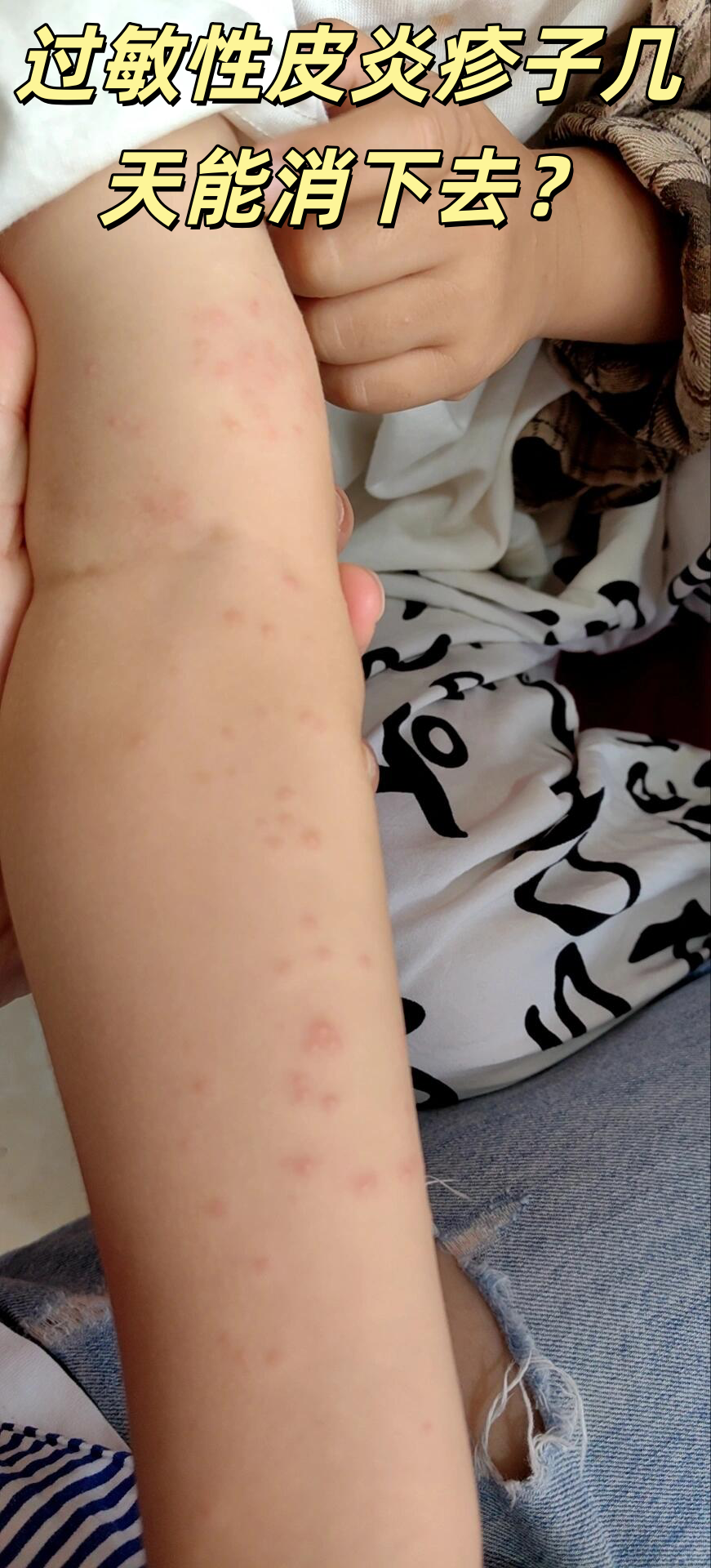 通常和病情轻重,治疗是否及时等有关哦～轻度症状的话,避开过敏原并做