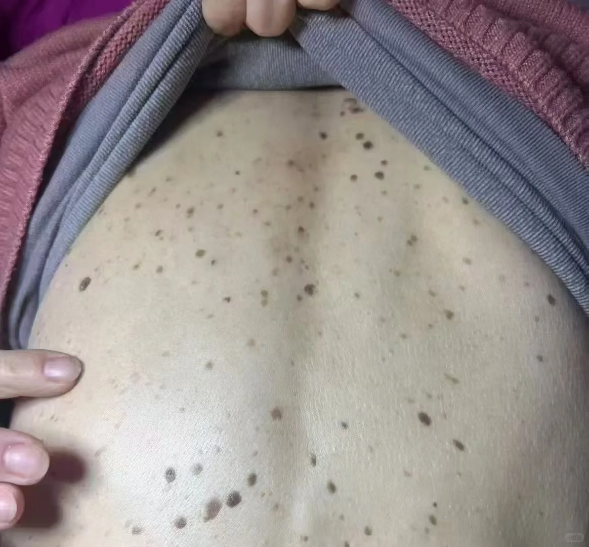 扁平疣的症状和图片 扁平疣是由人乳头瘤病毒
