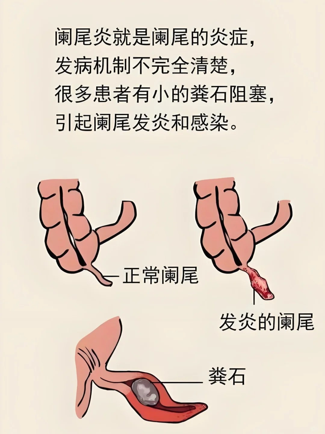 阑尾 阑尾像一条细细的小尾巴藏在右下腹的盲肠末端长度一般在6