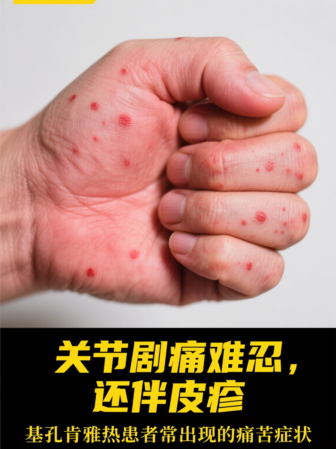 基孔肯雅热能自愈吗 基孔肯雅热是由基孔肯雅病毒