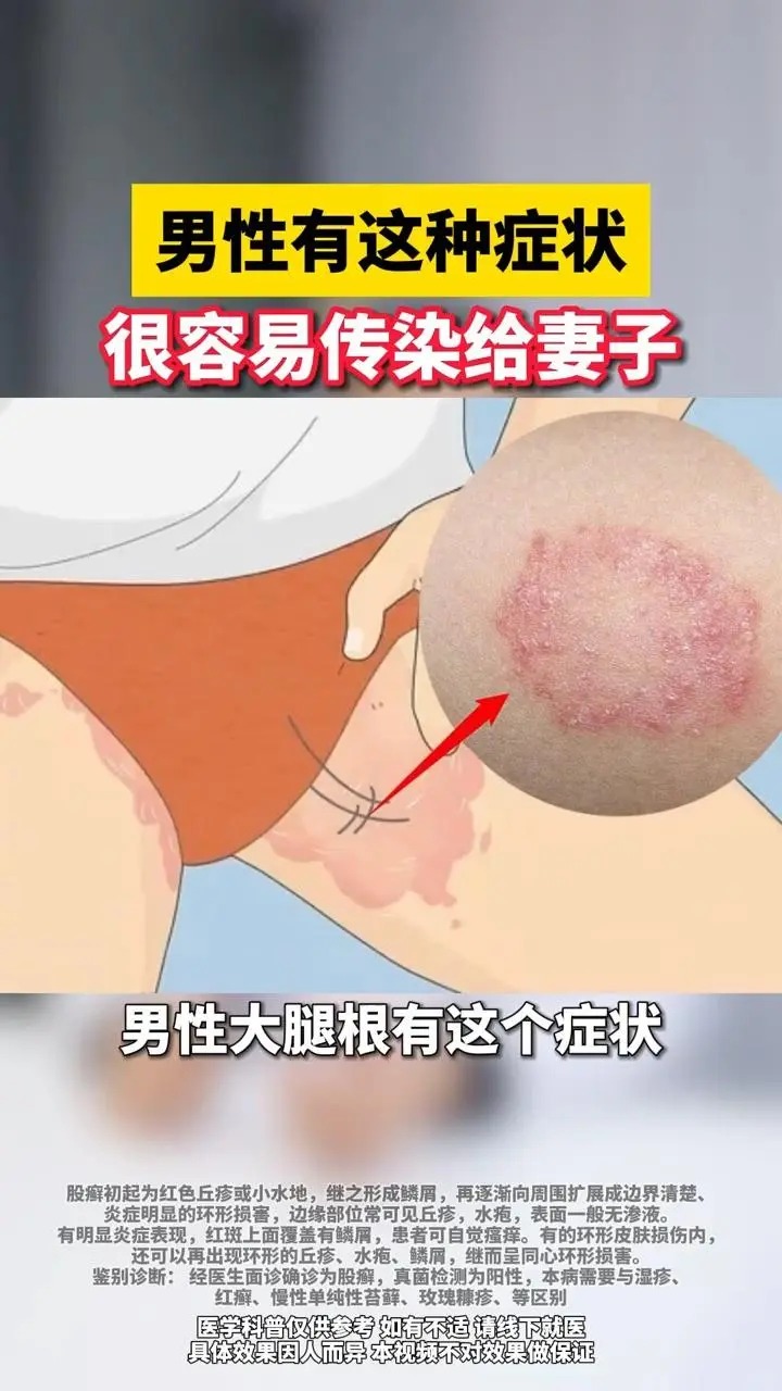 股癣 股癣是一种常见的皮肤真菌感染,多发生在腹股沟,会阴,肛周等部位