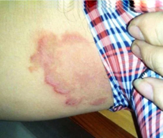 股癣 股癣是一种常见的皮肤真菌感染,多发生在腹股沟,会阴,肛周等部位