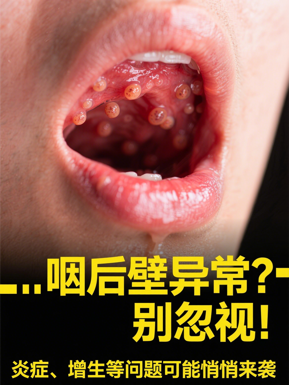 正常情况下,当我们借助工具观察咽后壁时,会发现它呈现淡红色,就像
