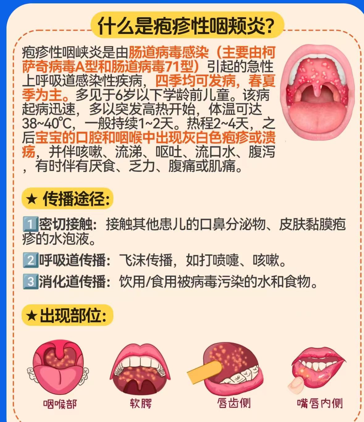 儿童咽峡炎的三个阶段