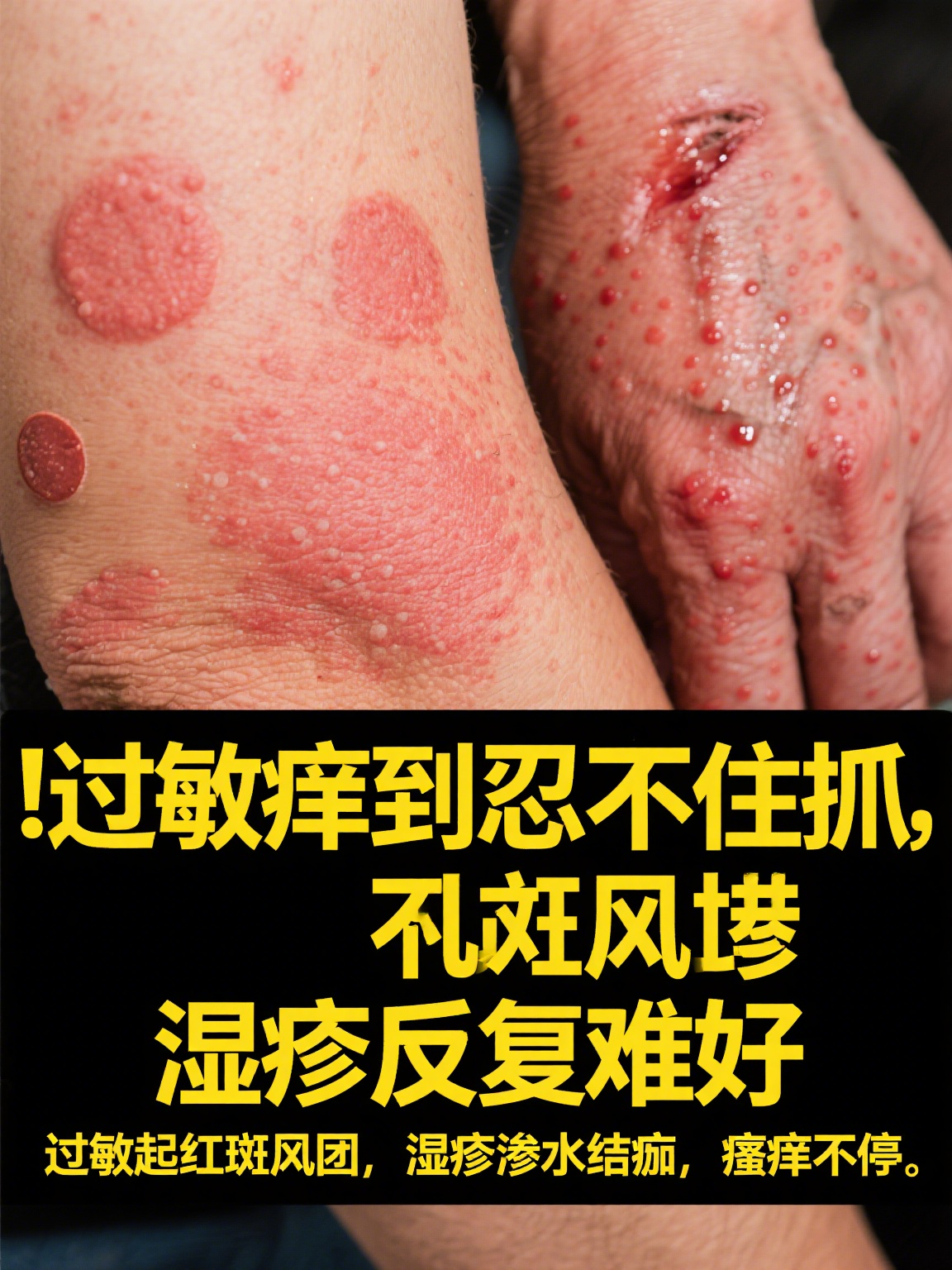 过敏和湿疹常被混淆,但其实是两种不同的皮肤