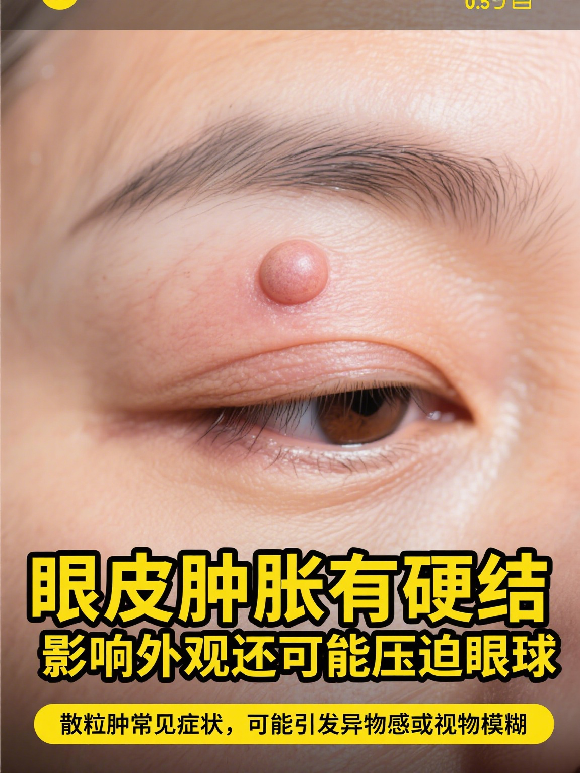 刚开始时,眼皮上可能只噬⒘Ｖ  霰粒肿