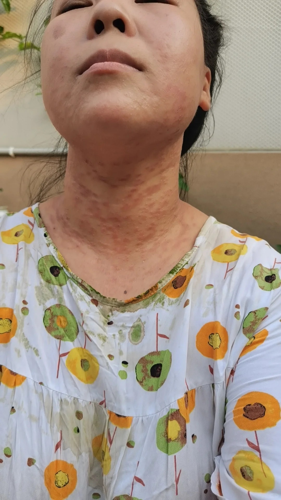 热疹症状图片 热疹,也叫痱子,常出现在夏季或炎热环境中