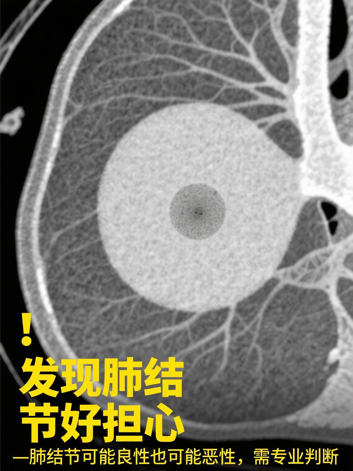 肺结节是指在肺部ct或胸片检查中发现的直径≤3