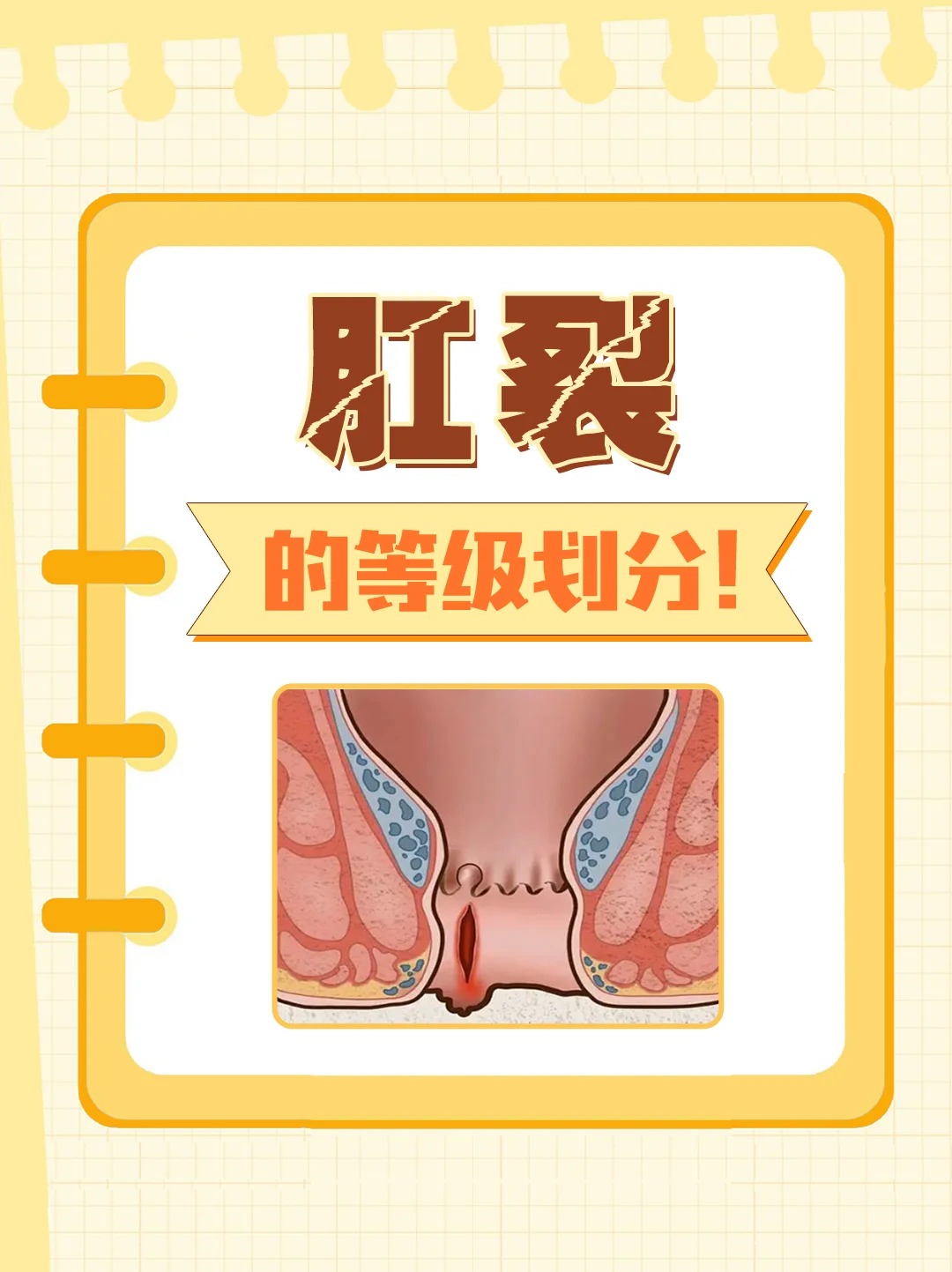 肛裂一二三期图片:深入了解肛裂分期 肛裂,简单来说,就是肛管皮肤全层