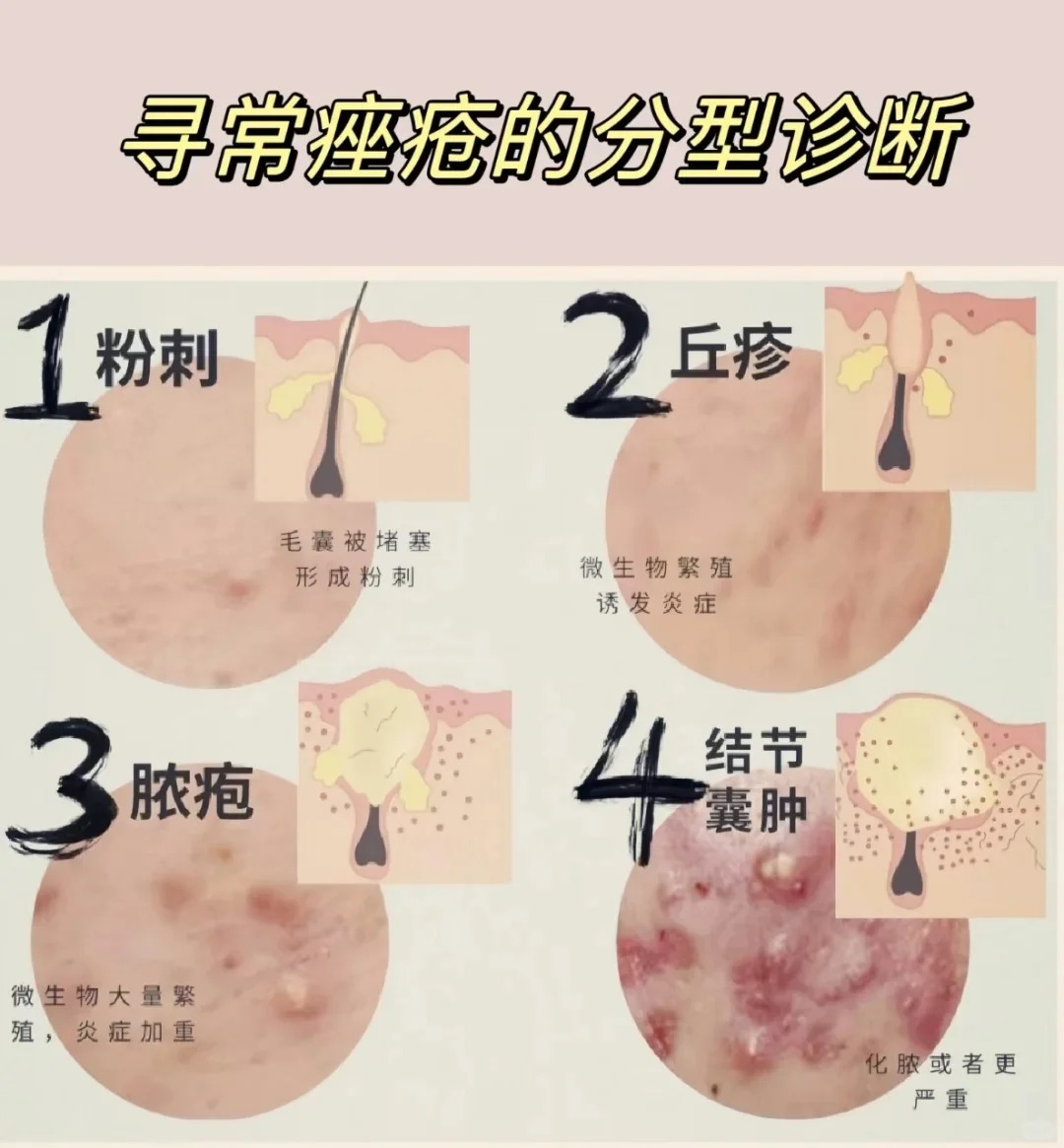 疮 疮是一种常见的皮肤软组织感染,通常由细菌