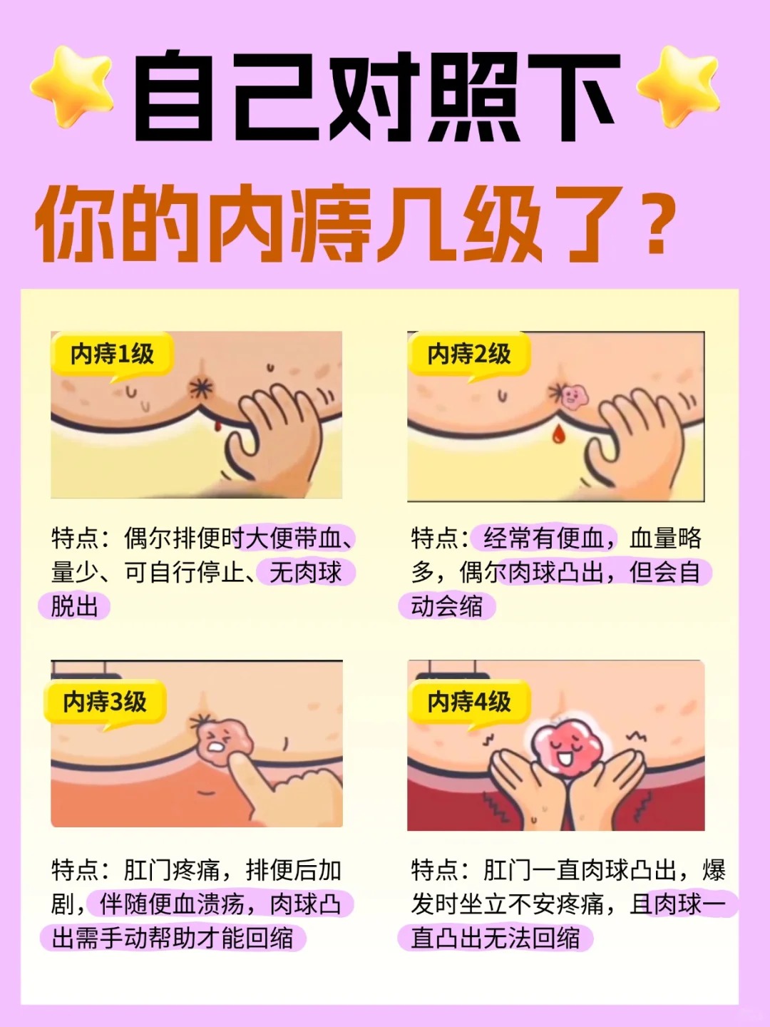 痔疮24种图片:带你全面认识痔疮 痔疮,这一常见肛肠疾病,可分为内痔