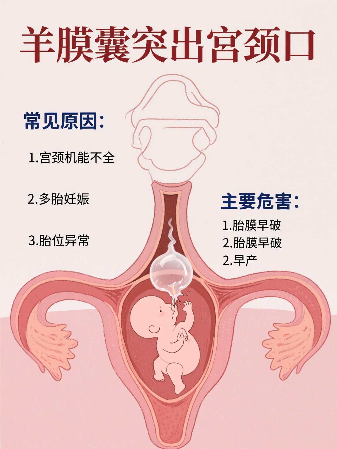 从相关图片中能看到,原本应在子宫内的羊膜囊部分下移至宫颈口位置
