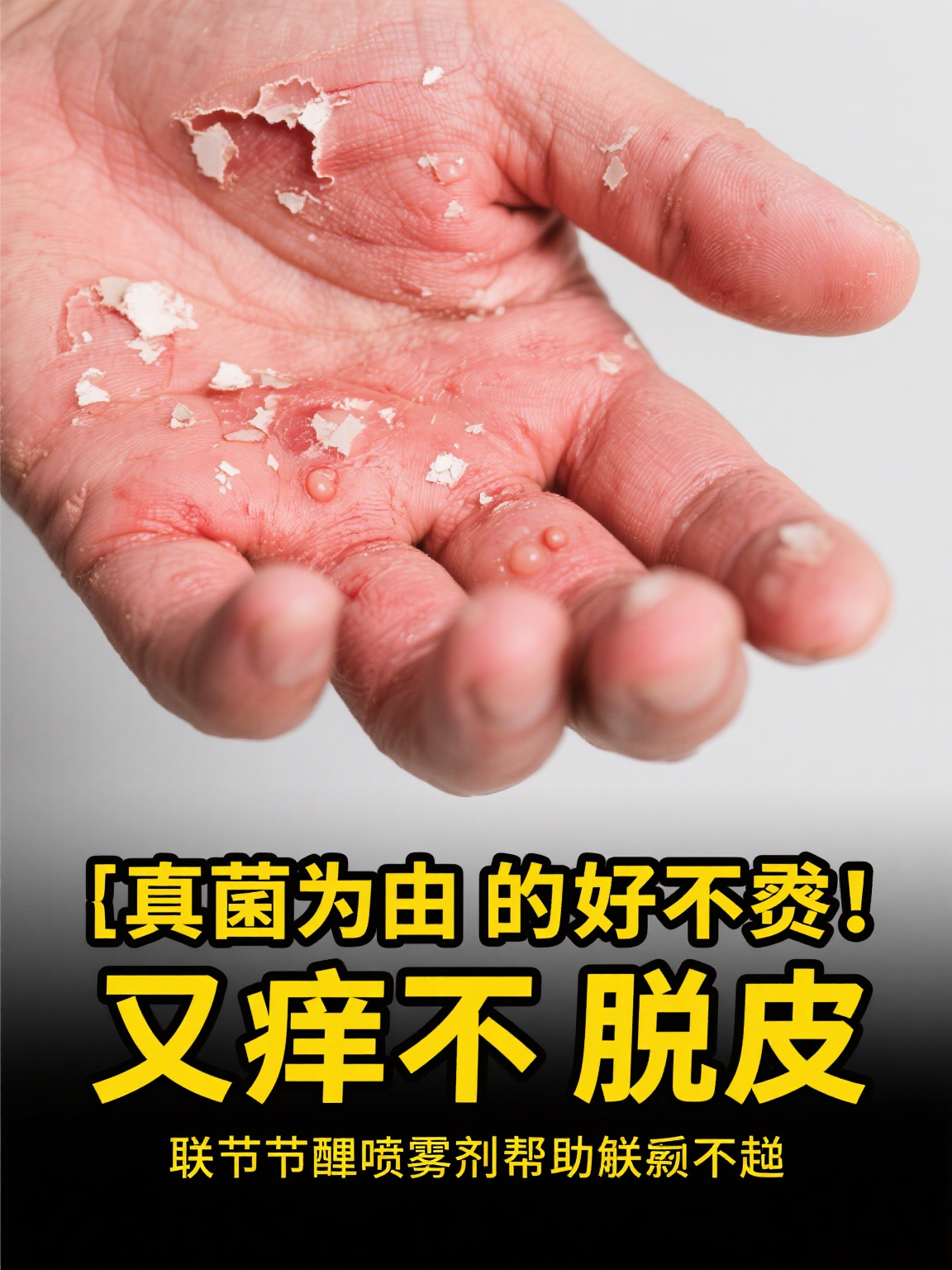 联苯苄唑喷雾剂是一种常见的外用抗真菌药物,在皮肤