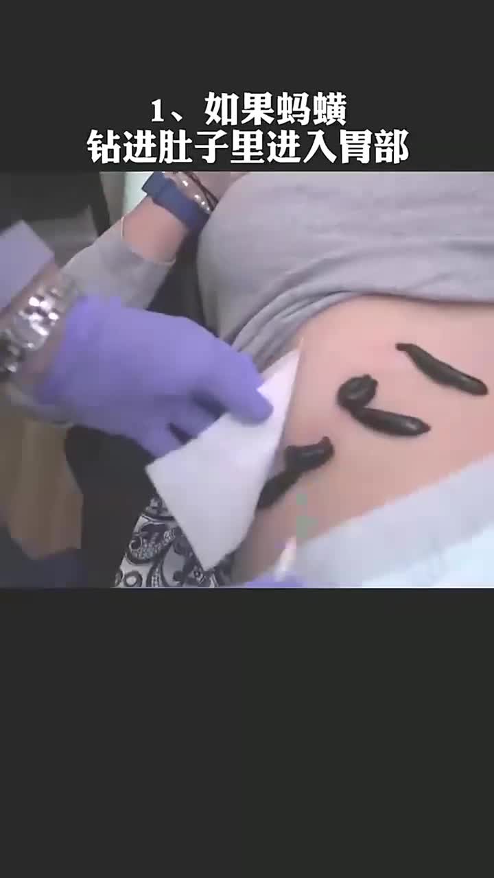 水蛭钻进肚子里怎么办