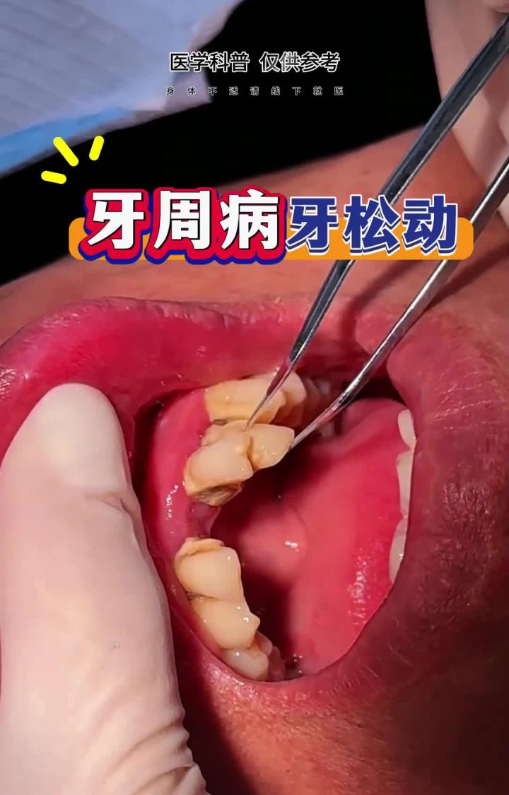典型的牙周病,牙齿3度松动还有厚厚的牙石,这颗牙需要拔除了