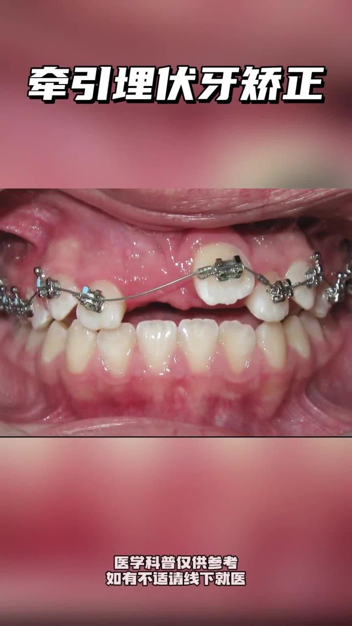 埋伏牙牵引矫正 口腔健康
