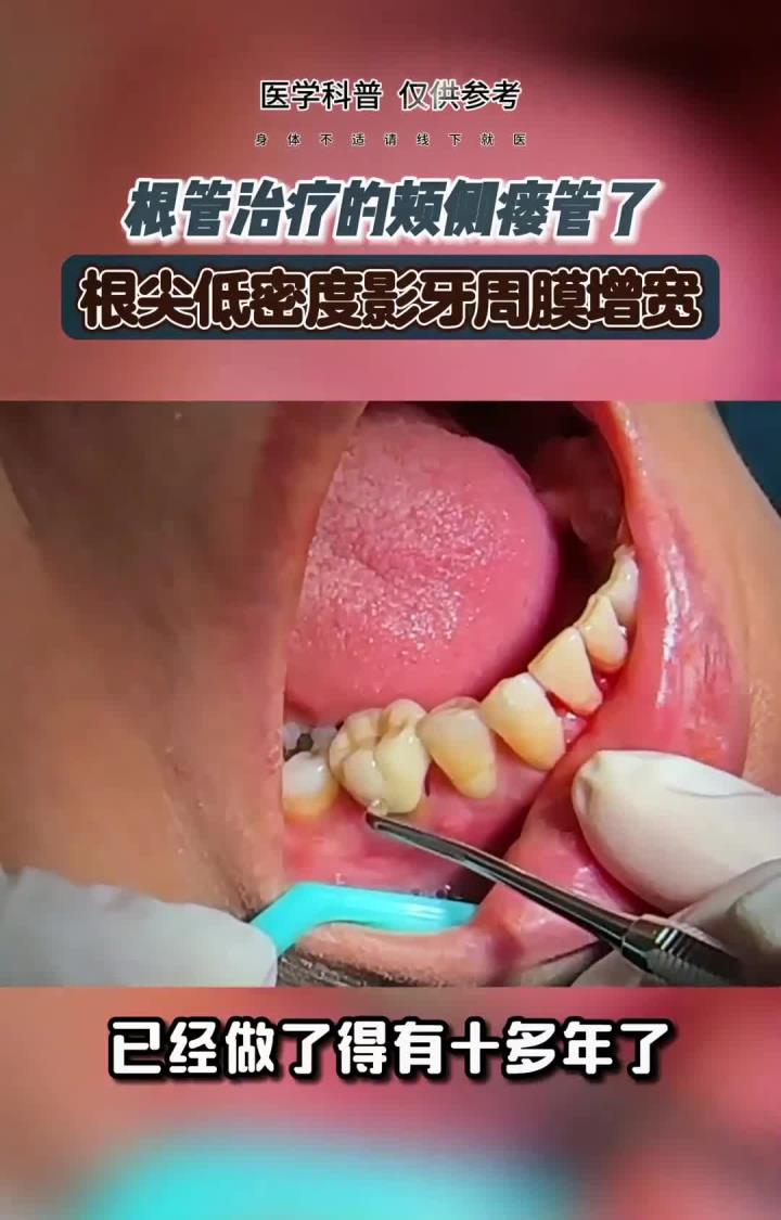 根管治疗过的牙,根尖瘘管了怎么办