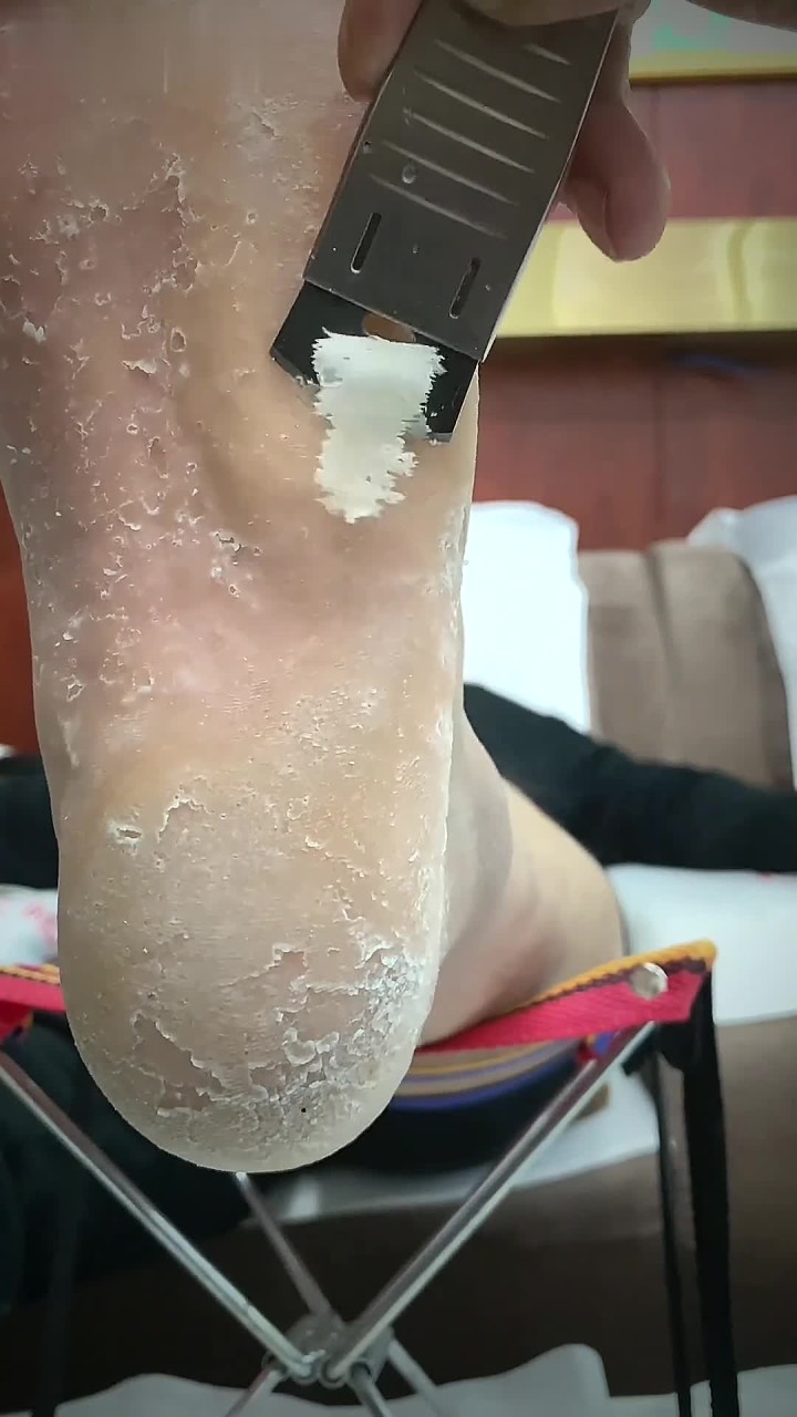 脚底板的老茧怎么清除 专业的事交给专业的人来做更靠谱 脚后跟硬皮太