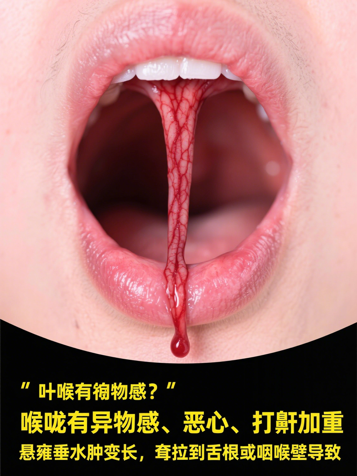 我们喉咙里那个悬着的"小舌头",学名叫悬雍垂,它突然变长下垂可不是