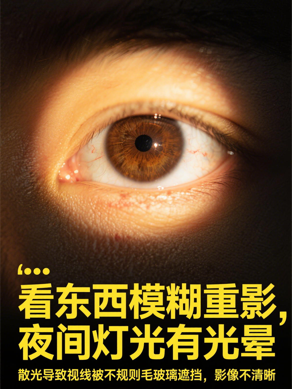 角膜或晶状体形状不够圆润,如同被挤压的足球,导致平行光线进入眼睛后
