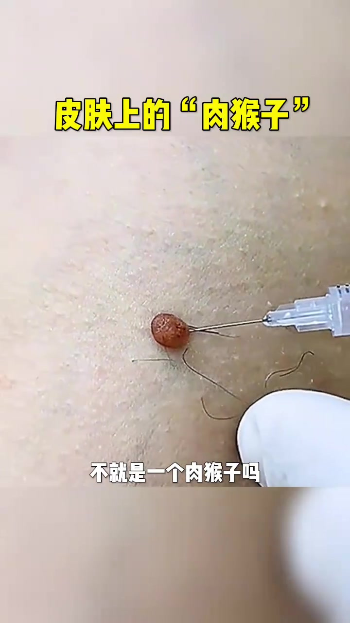 皮肤上的"肉猴子",直接嘎?这酸爽