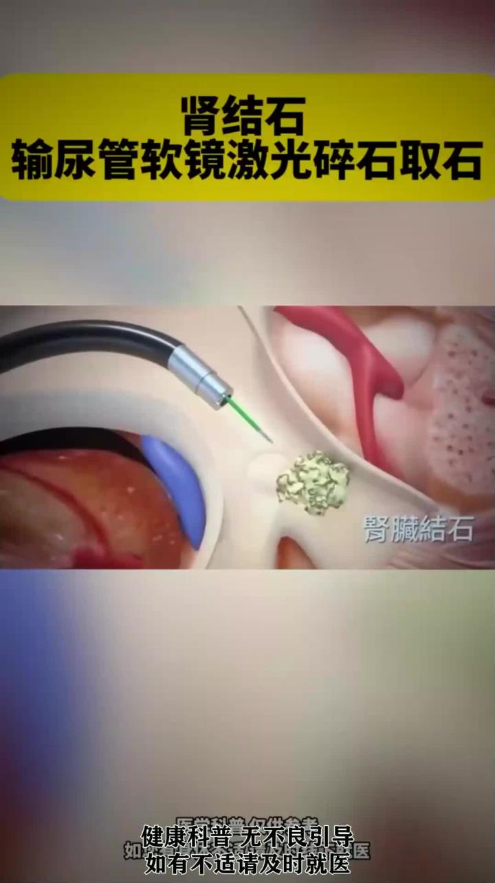 肾结石 输尿管软镜激光碎石取石
