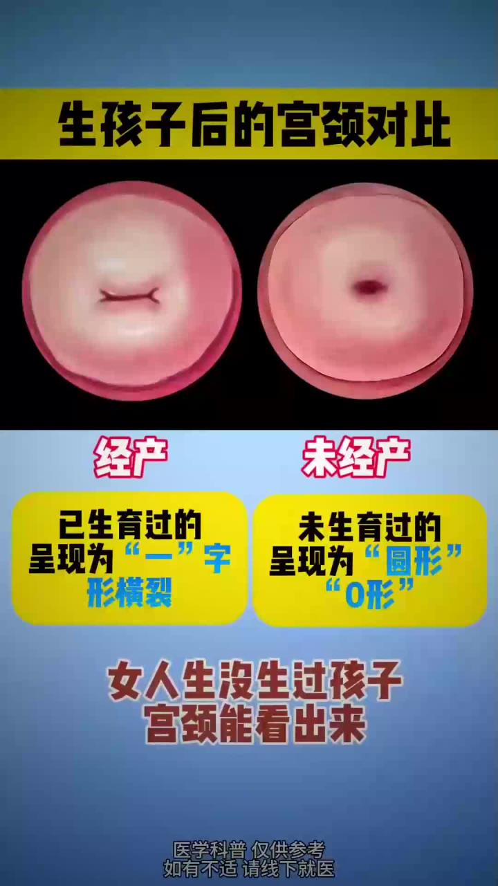 生孩子后的宫颈对比