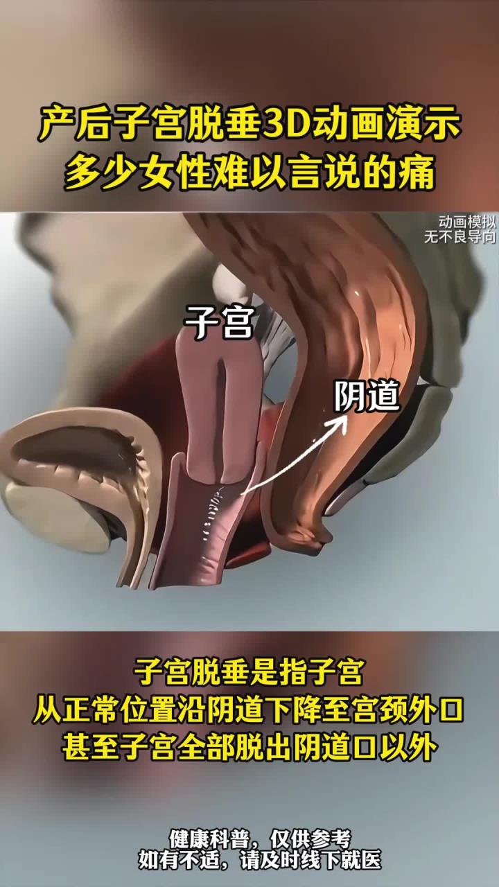产后子宫脱垂3d动画演示