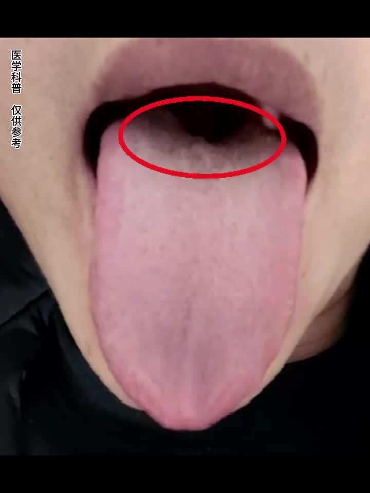 舌根这里明显是凹陷的,这是因为肾气不足了
