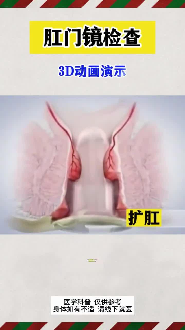 肛门镜检查 3d动画演示