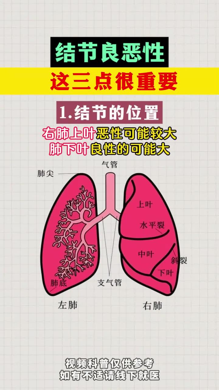 肺结节的 良恶性这三点很重要