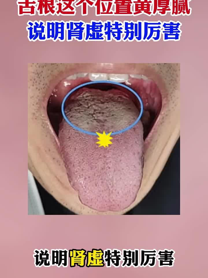 舌根这个位置黄厚腻说明肾虚特别厉害