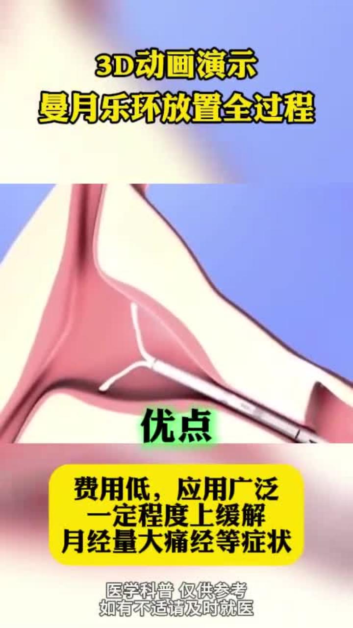 3d动画演示曼月乐环放置全过程