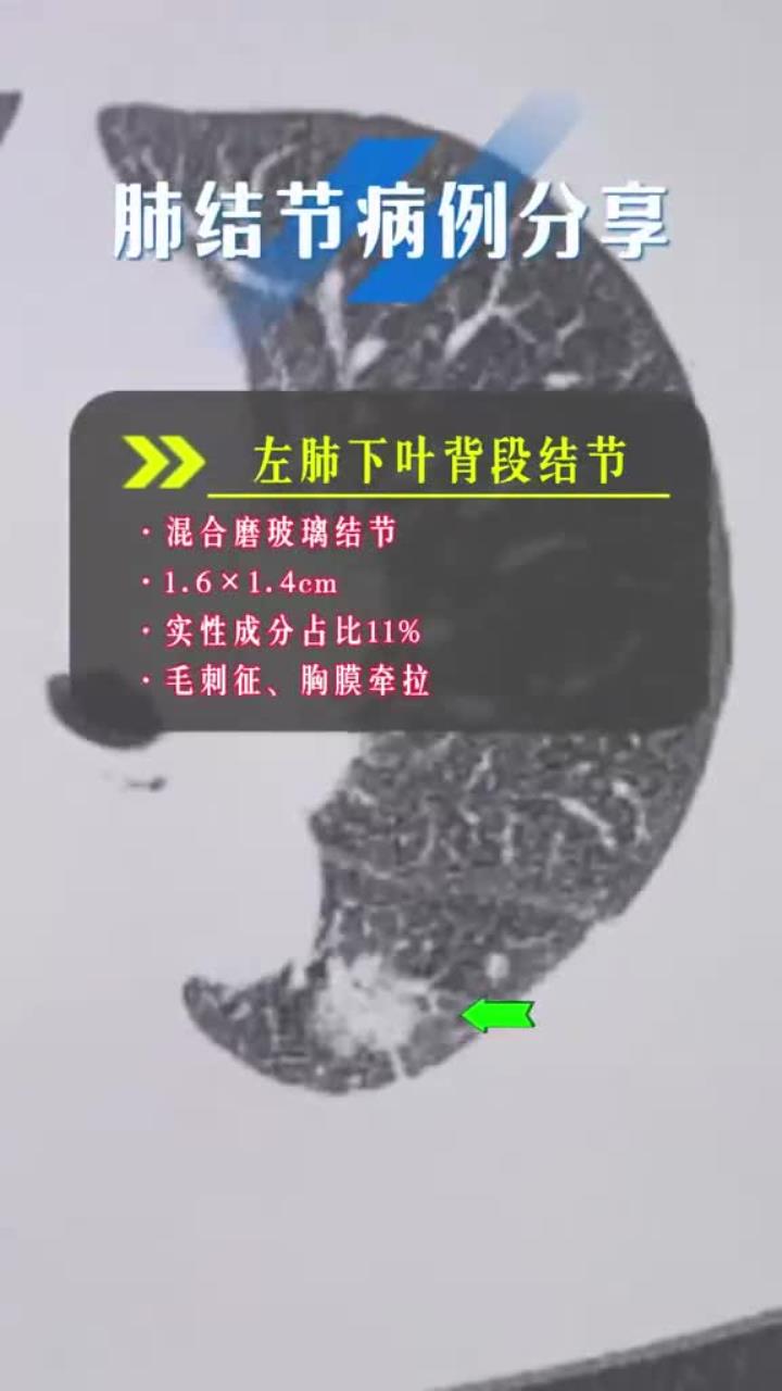 肺结节病例分享:左肺下叶背段混合磨玻璃结节,毛刺征,胸膜牵拉征,病理