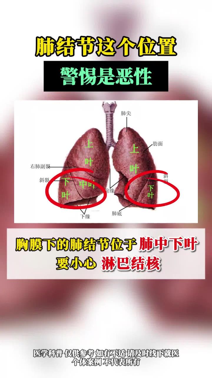 肺结节这个位置警惕是恶性!
